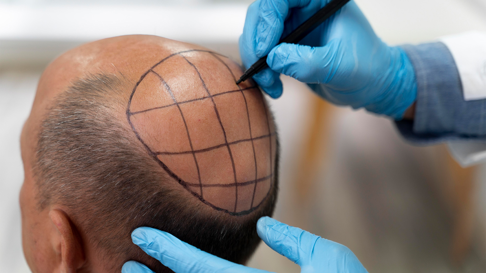 هل فكرت في زراعة الشعر؟ إليك كل ما تحتاج معرفته
